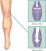 image of vein  - varicose veins - JPG 